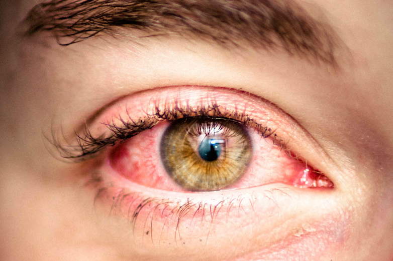 what makes eyes red when high